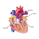 minimally invasive mitral valve repair surgery technique illustration